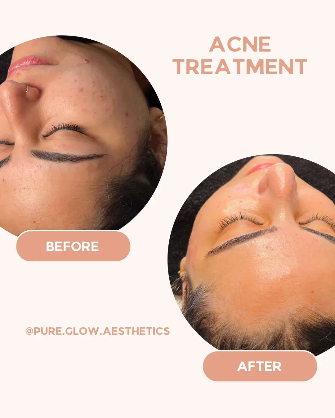 Acne Treatments treatment at Pure Glow Aesthetics, Birmingham