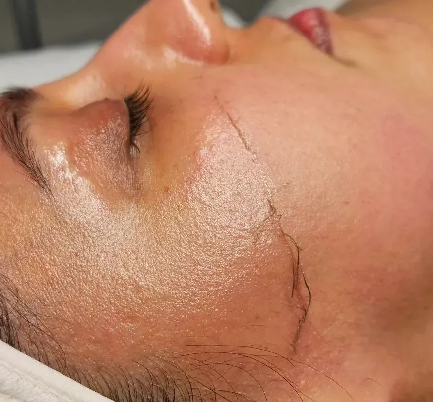 Dermaplaning treatment at Pure Glow Aesthetics, Birmingham