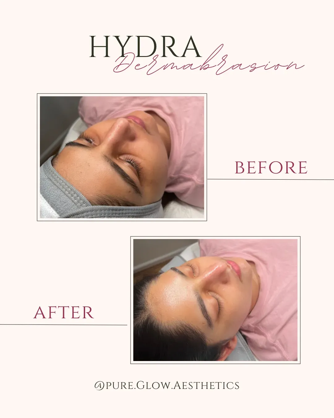 Hydradermabrasion treatment at Pure Glow Aesthetics, Birmingham