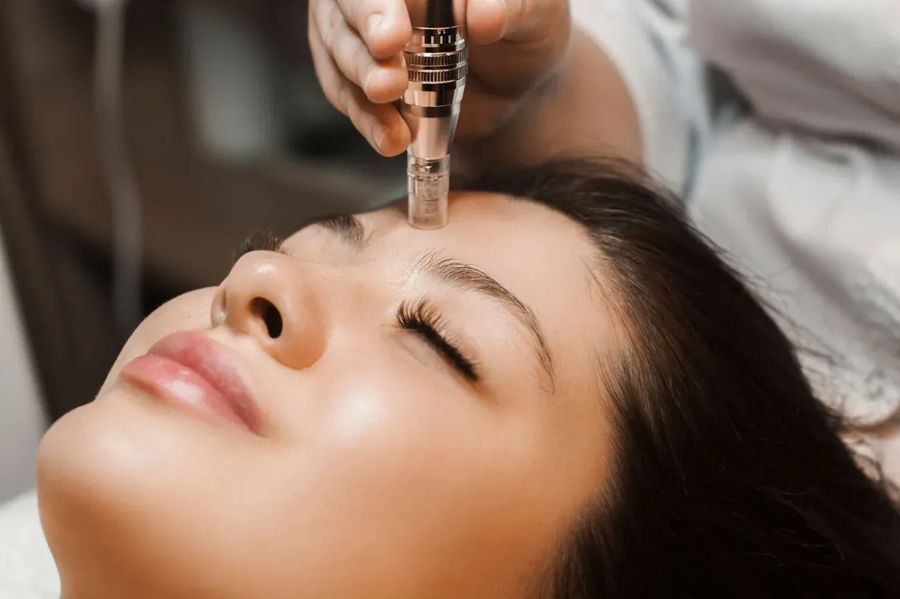 Microneedling treatment at Pure Glow Aesthetics, Birmingham
